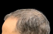 hair restoration