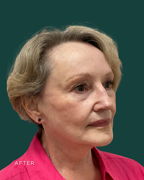 facelift before & after photo