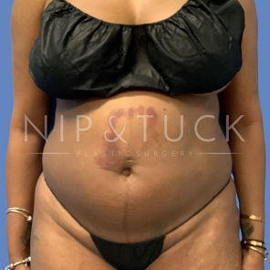 Awake Liposuction Before