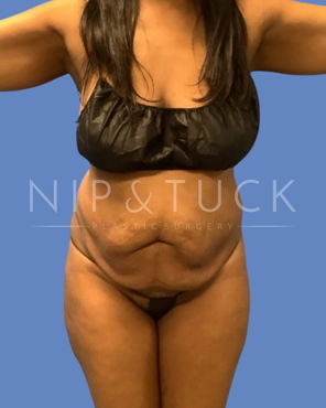 Awake Liposuction Before