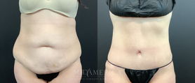 tummy tuck before & after