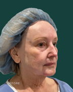 facelift before & after photo
