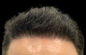 hair restoration