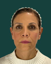 facelift before & after photo