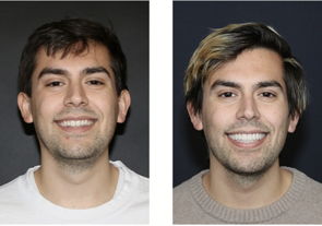 TMD Therapy before & after 2