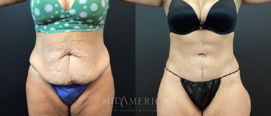 tummy tuck before & after