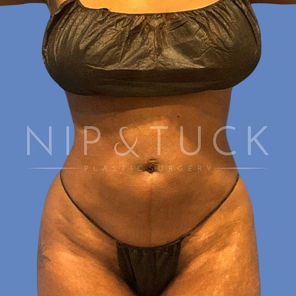 Awake Liposuction After