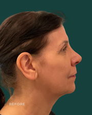 facelift before & after photo
