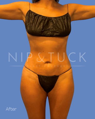 Awake Liposuction After