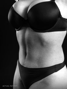 gandolfi drainless tummy tuck patient