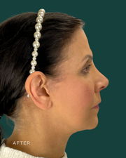 facelift before & after photo