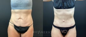 tummy tuck before & after