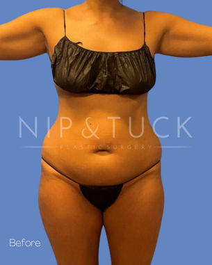 Awake Liposuction Before