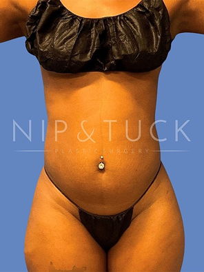 Awake Liposuction Before