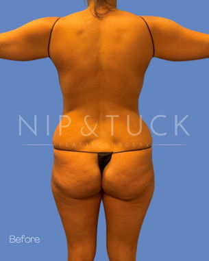 Awake Liposuction Before