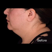 facelift before & after photo