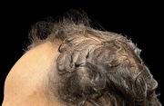 hair restoration