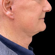 facelift before & after photo