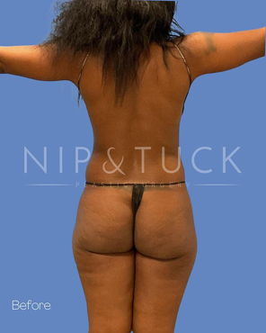 Awake Liposuction Before
