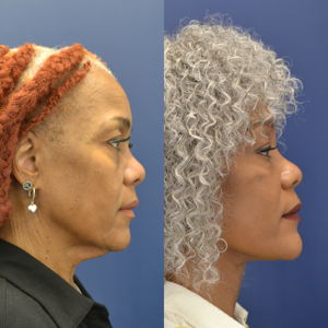 Facelift Before & after