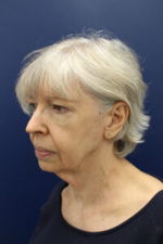 Facelift Before & after