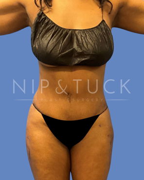 Awake Liposuction After