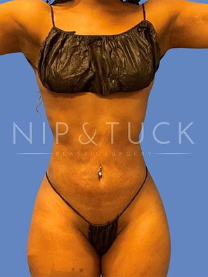 Awake Liposuction After