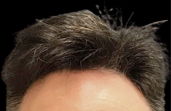 hair restoration