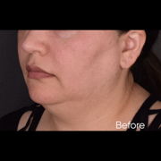 facelift before & after photo