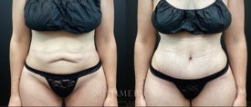 tummy tuck before & after