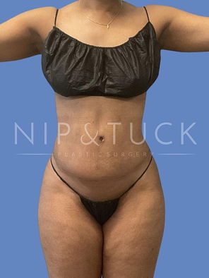 Awake Liposuction After