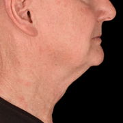 facelift before & after photo