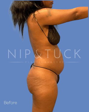 Awake Liposuction Before