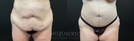 tummy tuck before & after