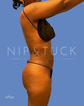 Awake Liposuction After
