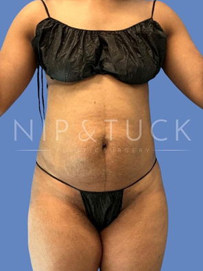 Awake Liposuction Before