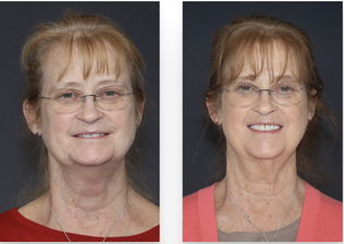 TMD Therapy before & after 4