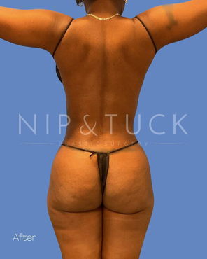 Awake Liposuction After